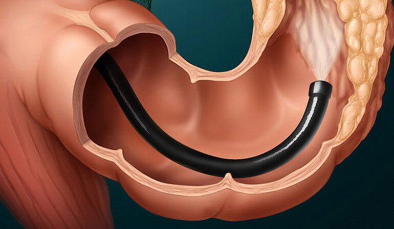 علائم ابتدایی سرطان روده
