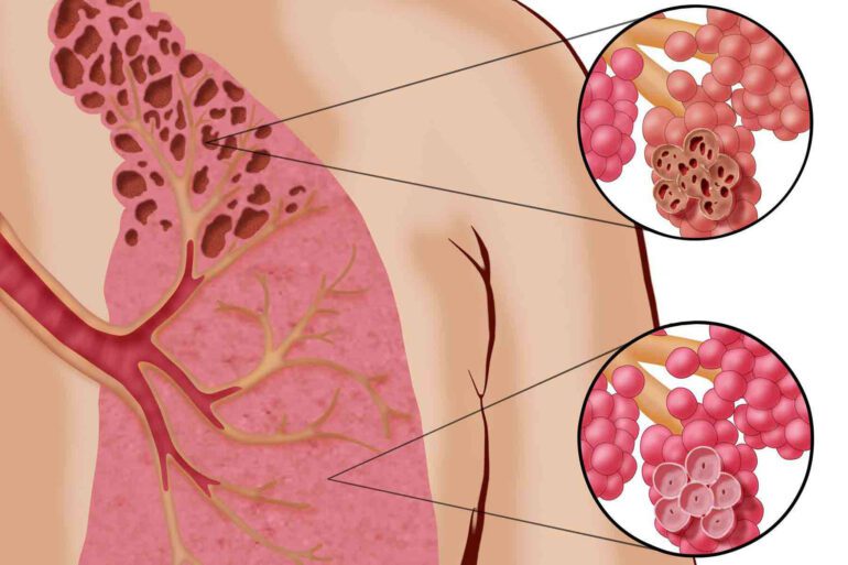 علائم مرگ در سرطان ریه