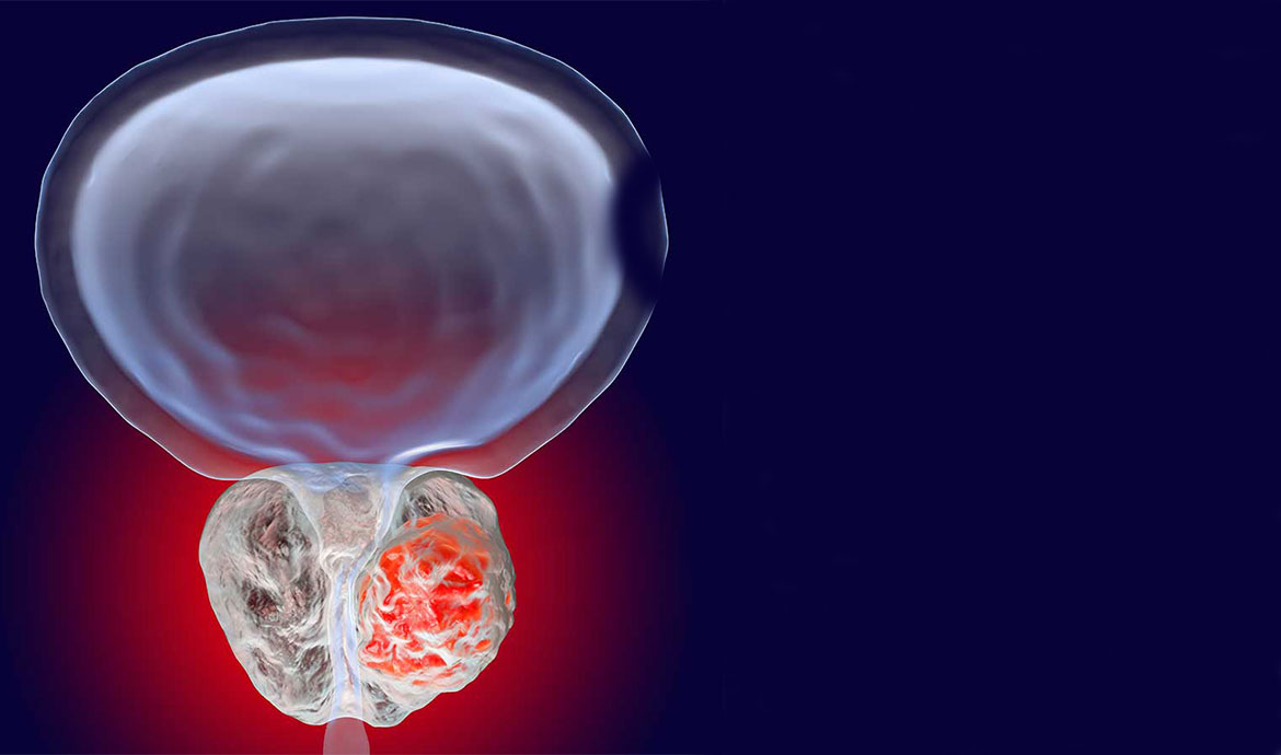 علائم سرطان پروستات
