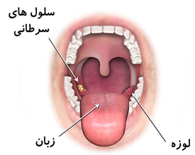 درمان سرطان بدخیم زبان