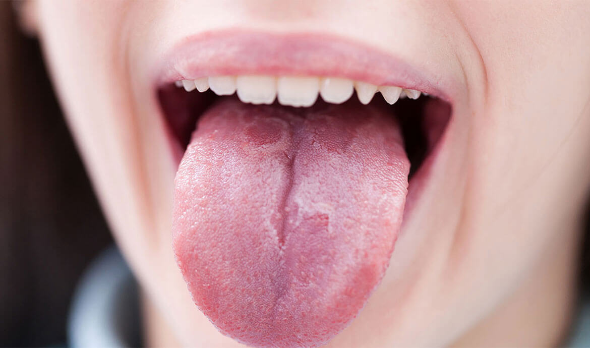 درمان سرطان بدخیم زبان و تشخیص به موقع بیماری