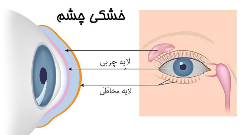 درمان خشکی چشم