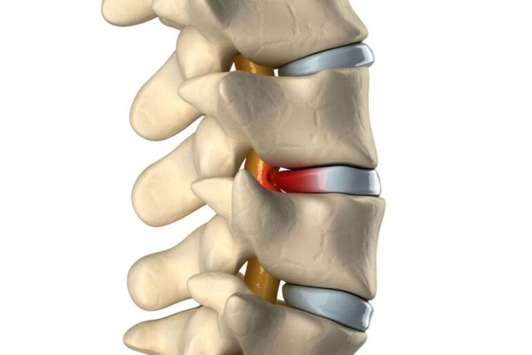 علائم پارگی دیسک گردن