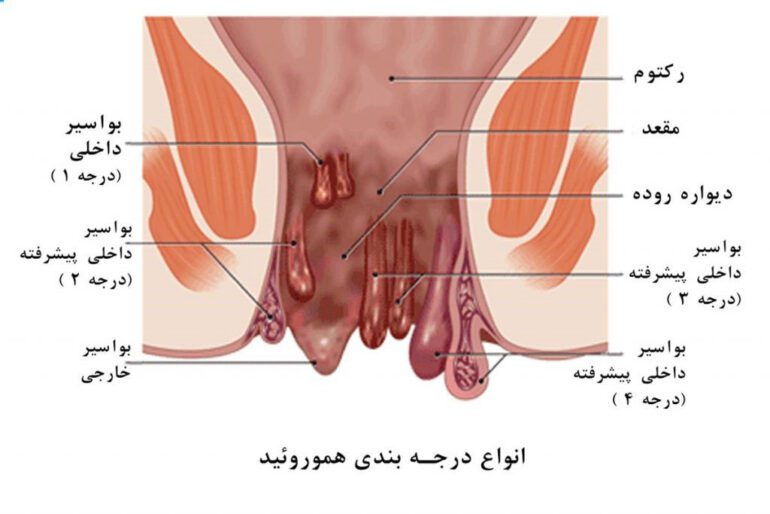 علائم بواسیر در زنان