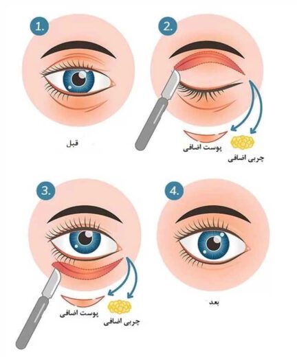 عوارض بلفاروپلاستی چیست