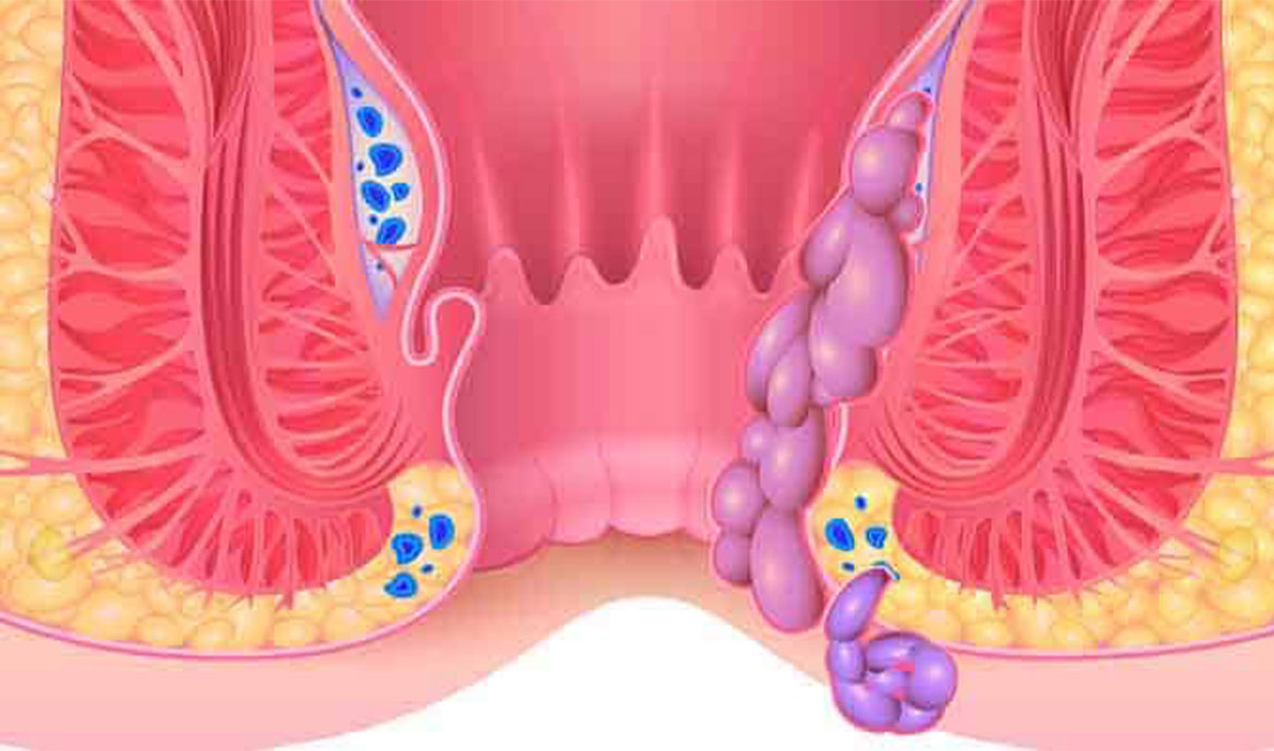 علائم بواسیر در زنان