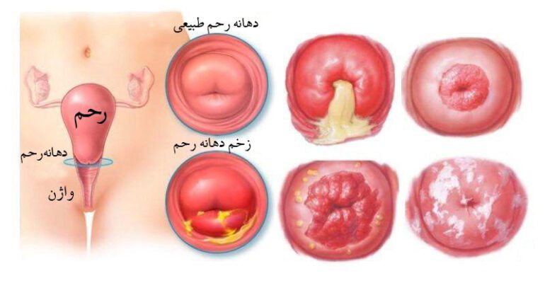 بهترین پماد برای زخم دهانه رحم