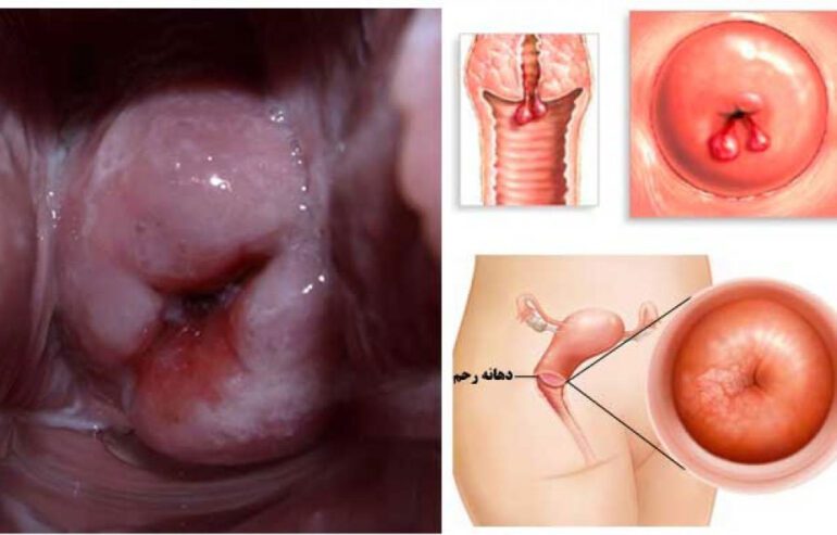 بهترین پماد برای زخم دهانه رحم