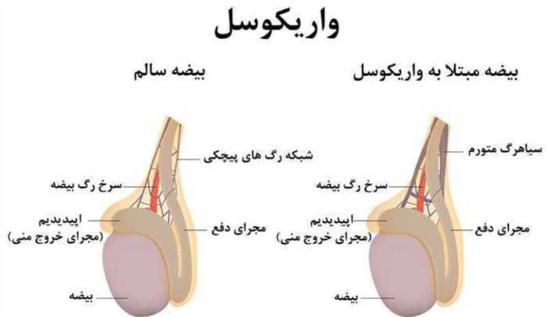 از کجا بفهمیم واریکوسل داریم